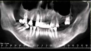 Are CT Scans Important for Dental Implants [upl. by Norvan]