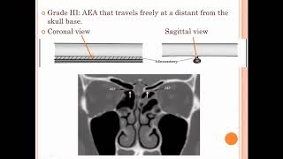 anterior ethmoidal artery overview [upl. by Aniraz]