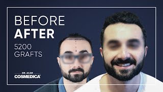 100 Natural Hairlines with Dr Acar [upl. by Ahsilad338]