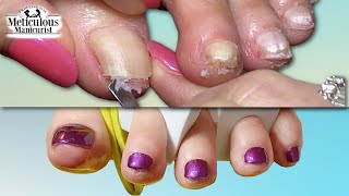 SQUEEZED Satisfying Toenail TRANSFORMATION Progress [upl. by Ahsenor]