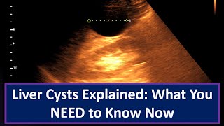 Liver Cysts Explained What You NEED to Know Now [upl. by Suzi]