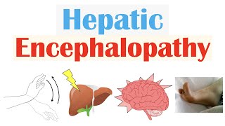 Hepatic Encephalopathy  Pathophysiology Triggers Signs amp Symptoms Diagnosis Treatment [upl. by Balf]