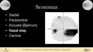 7 EXAMINATION Visual Field Changes in Glaucoma [upl. by Kavanaugh821]