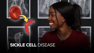 Sickle Cell Disease Understanding the Causes Symptoms and Sickle Cell Crisis [upl. by Htabmas]