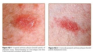 PITYRIASIS ROSEA  Materi Kedokteran  Dermatologi [upl. by Alard]