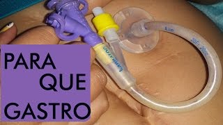 Gastrostomía Qué es pros y contras [upl. by Tlok902]