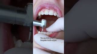 Enameloplasty  Filing Edges of Your Teeth w TheBracesDoc [upl. by Okuy]