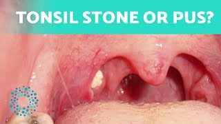 The Difference Between TONSIL STONES and TONSILITIS 👄 How to Tell Them Apart [upl. by Attaynek]