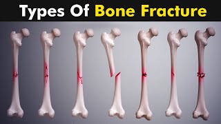 Common types of Bone fracture  3D animation [upl. by Waylen]