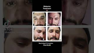 Melasma treatment 🫶🏼 doctor explore skintreatment [upl. by Rusticus800]