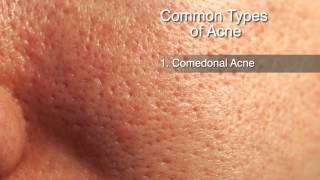 How to Treat Different Types of Acne [upl. by Haroppiz]