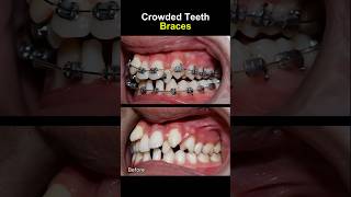 Teeth very crowded and crooked before braces orthodontist braces dentist [upl. by Nyrtak]