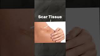 MPS Therapy Explained Using Microcurrent for Muscle Relaxation amp Scar Tissue Treatment [upl. by Braeunig845]