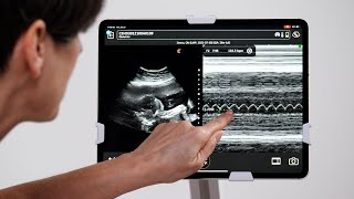 Fetal Heart Mmode [upl. by Asillam163]