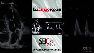 Curso de Ecocardioscopia Ecocardiografía básica [upl. by Nussbaum]