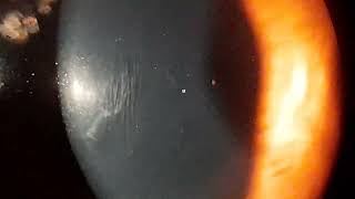 Vogts Striae in Keratoconus [upl. by Nymzaj951]