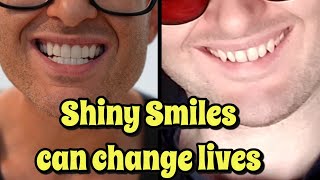 Shiny Smile Veneers  Honest 6 Month Review  Everything you need to know [upl. by Maggy455]