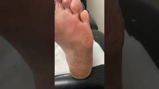 Quick amp Effective Corn and Callus Removal by Australian Podiatrist  Docpods [upl. by Jezabelle571]