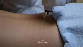 Treatment of Stretch Marks with Fractional CO2 Laser by Amoderm [upl. by Zaria507]