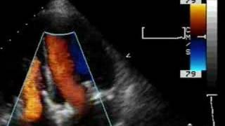 Prosthetic tricuspid valve and mitral valve [upl. by Ardnuasak]