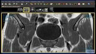 Hip Avulsion Fracture of the Anterior Inferior Iliac Spine [upl. by Ateuqirne140]