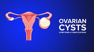 Ovarian Cysts  Symptoms and Complications Explained by an OBGYN [upl. by Paul988]