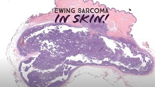 Ewing sarcoma arising in SKIN Australasian Dermpath 2022  Case 6 pathology dermatology [upl. by Spring]