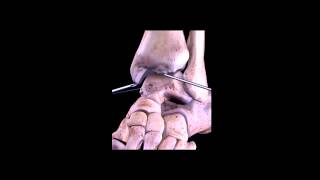 Artroscopia de tobillo pinzamiento Ankle arthroscopy impingement [upl. by Kohn]