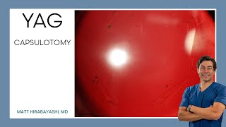 Routine YAG Capsulotomy [upl. by Mars]