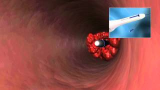 CLEANER15 Rotational Thrombectomy System [upl. by Battista]