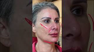 Harmonização Facial com muita naturalidade pela Dra Adriana Senra [upl. by Notnil]