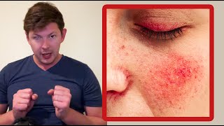 How To Fix Rose ca amp eczema With German New Medicine [upl. by Uhp197]