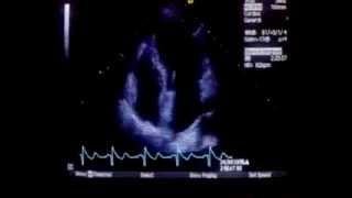 Echocardiography of the heart [upl. by Pedrick495]