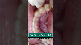 Got Teeth Deposits Get UltraSonic Scaling done Dr Srishti Bhatia teeth scaling [upl. by Ludba]