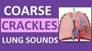 Crackles Coarse Lung Sounds  Crackles and Rales Breath Sounds Abnormal [upl. by Velick]