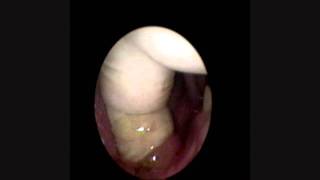 Sialolitiasis Litiasis Submaxilarwmv [upl. by Ear]