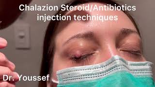 Chalazion Easiest and simplest Treatment with Steroid and Antibiotic Injections [upl. by Irpak]