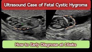 Multiple Fetal Congenital Anomalies  How to Diagnose Cystic Hygroma [upl. by Karrie832]