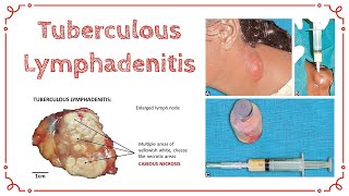 TUBERCULOUS LYMPHADENITIS  Stages Of TB Lymphadenitis  Cold Abscess  General Surgery [upl. by Eleanore286]