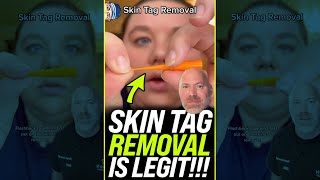 Skin Tag Removal is LEGIT 😱 shorts [upl. by Peoples]