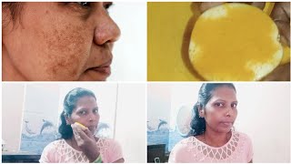 ಬಂಗುPigmentation ಸಮಸ್ಯೆಗೆ ಶಾಶ್ವತ ಪರಿಹಾರ  How to remove pigmentation amp dark spots [upl. by Wayolle]