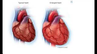 Cardiomegaly Video Lecture [upl. by Retsam52]