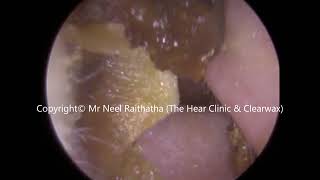 242  Soft Ear Wax Removal using Jobson Horne  Mr Neel Raithatha The Hear Clinic [upl. by Letreece573]