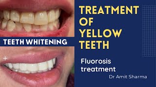 How dentist make yellow teeth white  Teeth whitening  Fluorosis treatment [upl. by Claire132]