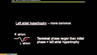 1215 Lead ECG Atrial Hypertrophy [upl. by Clawson533]