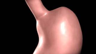 Gastric Bypass animation [upl. by Yvonne797]