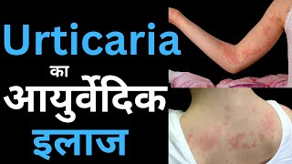 What is Urticaria Causes Home Remedies amp Ayurvedic Treatment [upl. by Avan867]