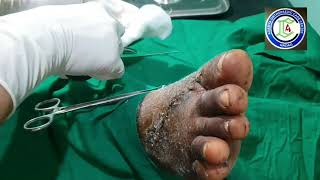 Dorsum Foot injury  Accidental axe injury foot  Kwire removal foot  Adamya Hosp videos [upl. by Wood]