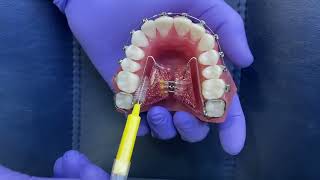 Rapid palatal expanderPCO [upl. by Leitao639]