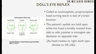 Dolls Eye Reflex  Oculocephalic Reflex  Brain death  Dr M B [upl. by Limber]